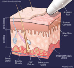 Silhouet-tone ® Essential Peel 411422 Microdermabrasion & Diamond Peel Device - Made in CANADA