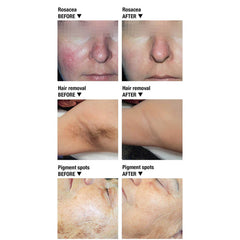 Silhouet Tone ® IPL 818 Professional Hair Removal & Rejuvenation System (Health Canada Approved) 411131